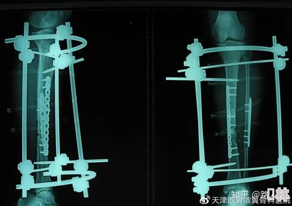 断尺(骨科)懒散蒲公英手术顺利完成两人开启漫长又甜蜜的复健生活