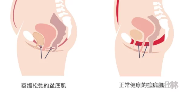 魔镜号产后骨盆修复科学修复盆底肌重塑辣妈好身材